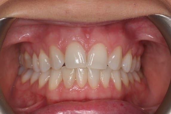 before invisalign lite