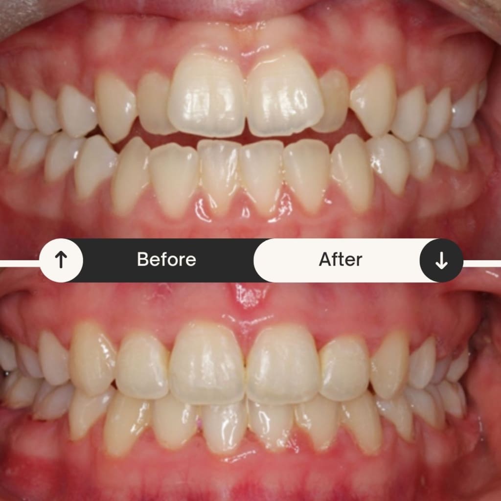 Is Invisalign Better Than Braces?