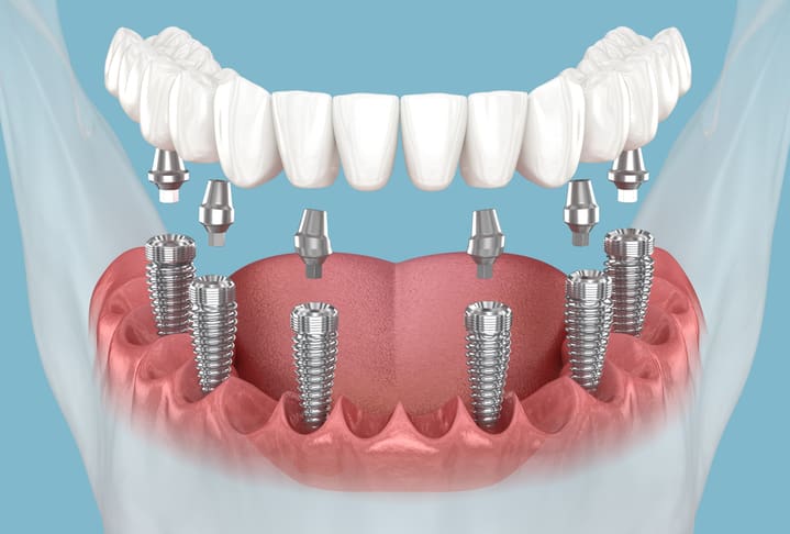 Dentures You Can Wear All The Time