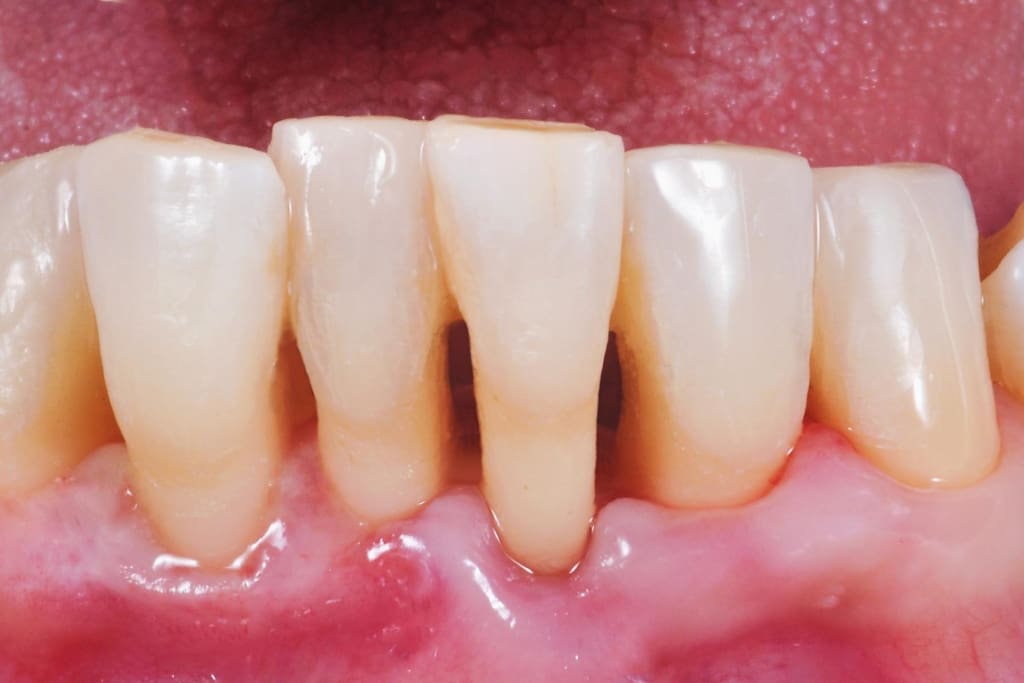 What Causes Gum Recession?