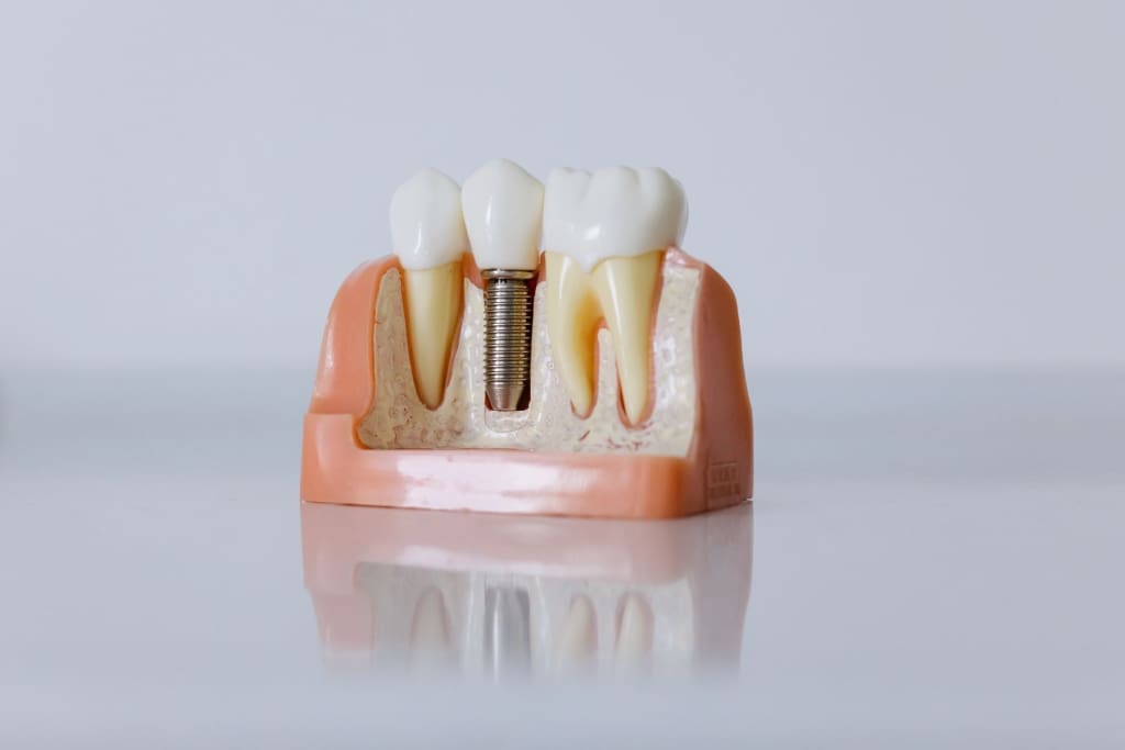 The Invisible Costs of Teeth Implants – Guide to Extra Fees
