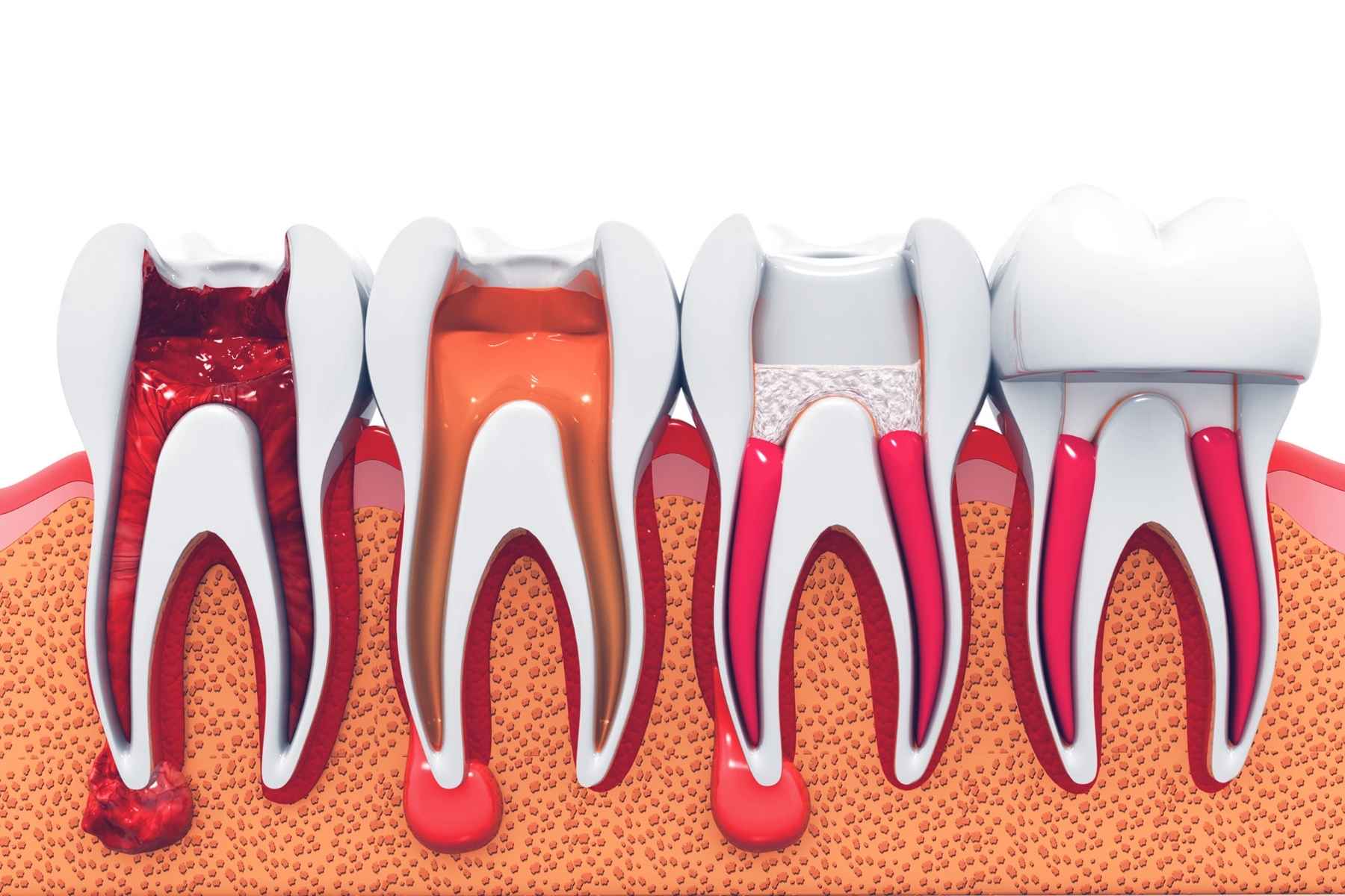 root canal image