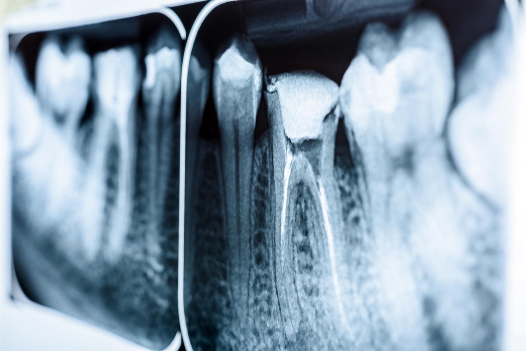root canal steps