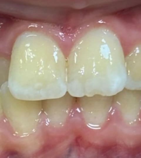 underbite before