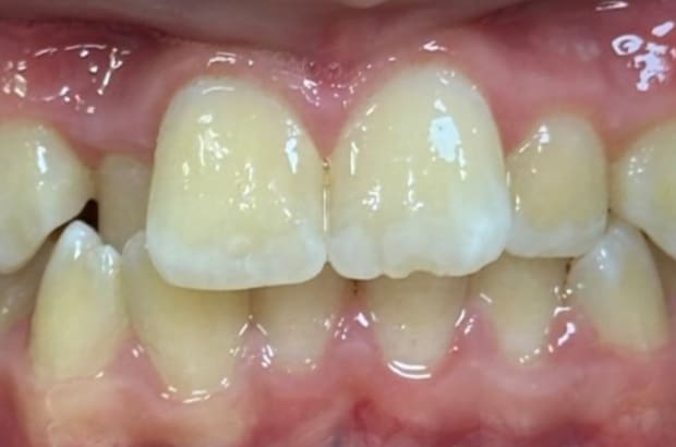 underbite before