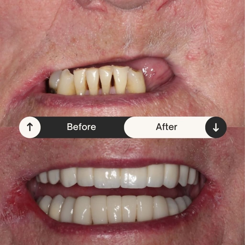 Every Type and Cost of Dental Implants