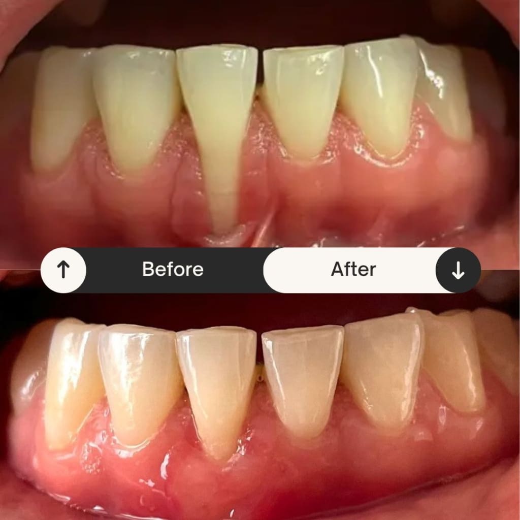 I Healed My Receding Gums