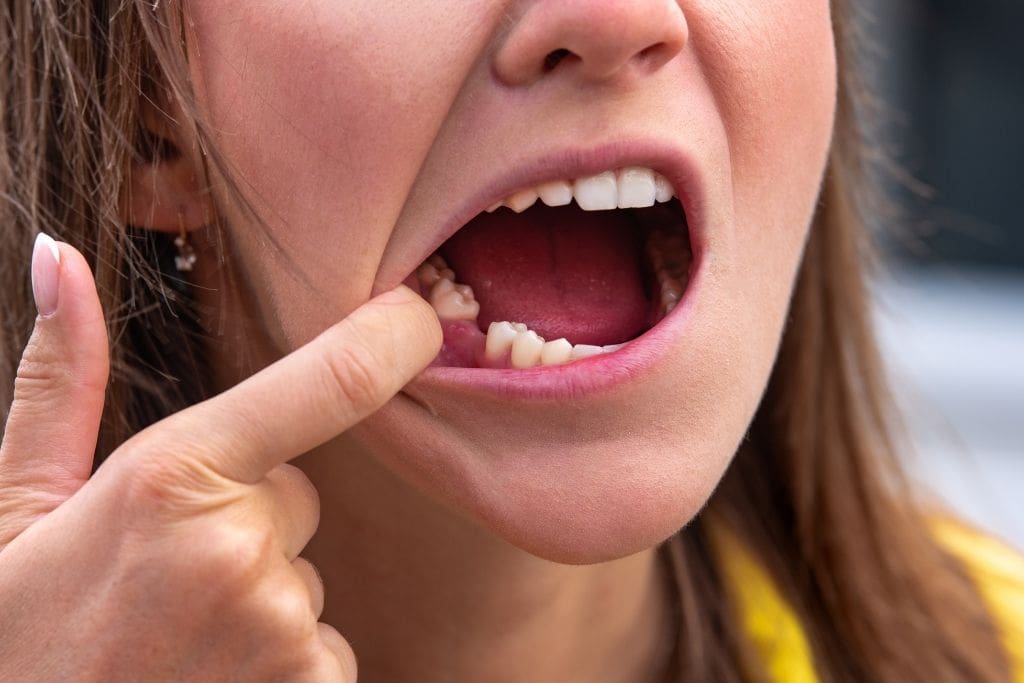 The Cost of a Molar Implant