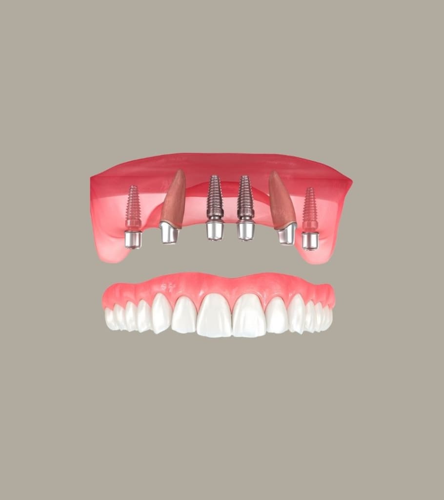All-on-4 Dental Implant Cost