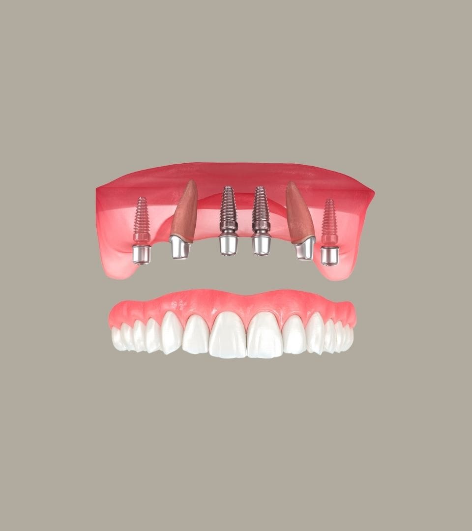 all on 4 implants