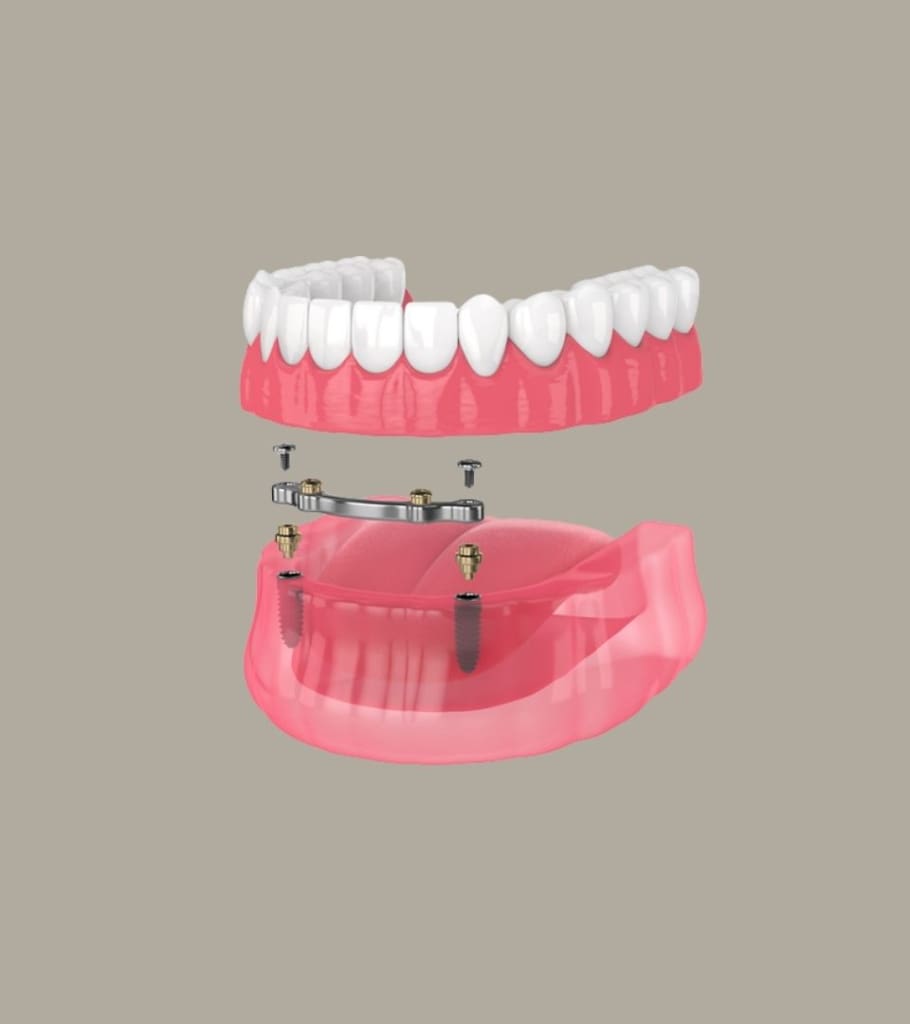 Dental Implants and Dentures – Do They Work Together?