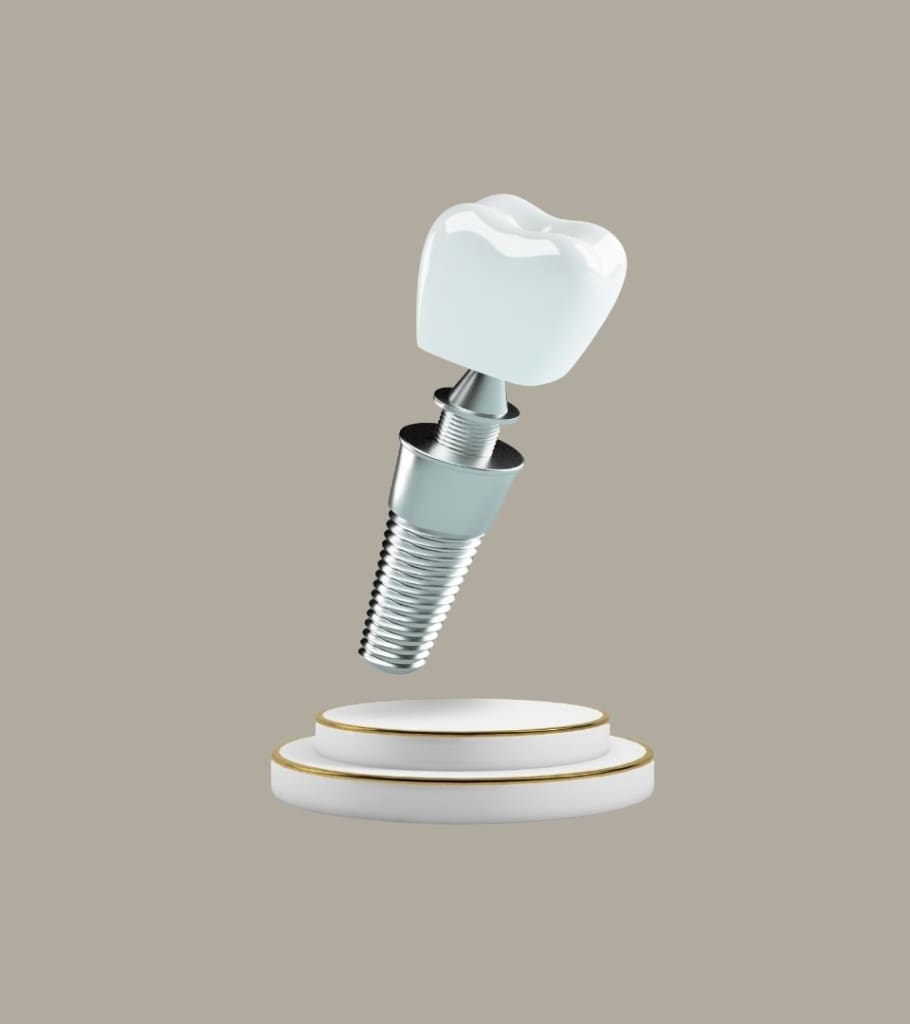 Screwless Dental Implants – The Only Times to Use Them