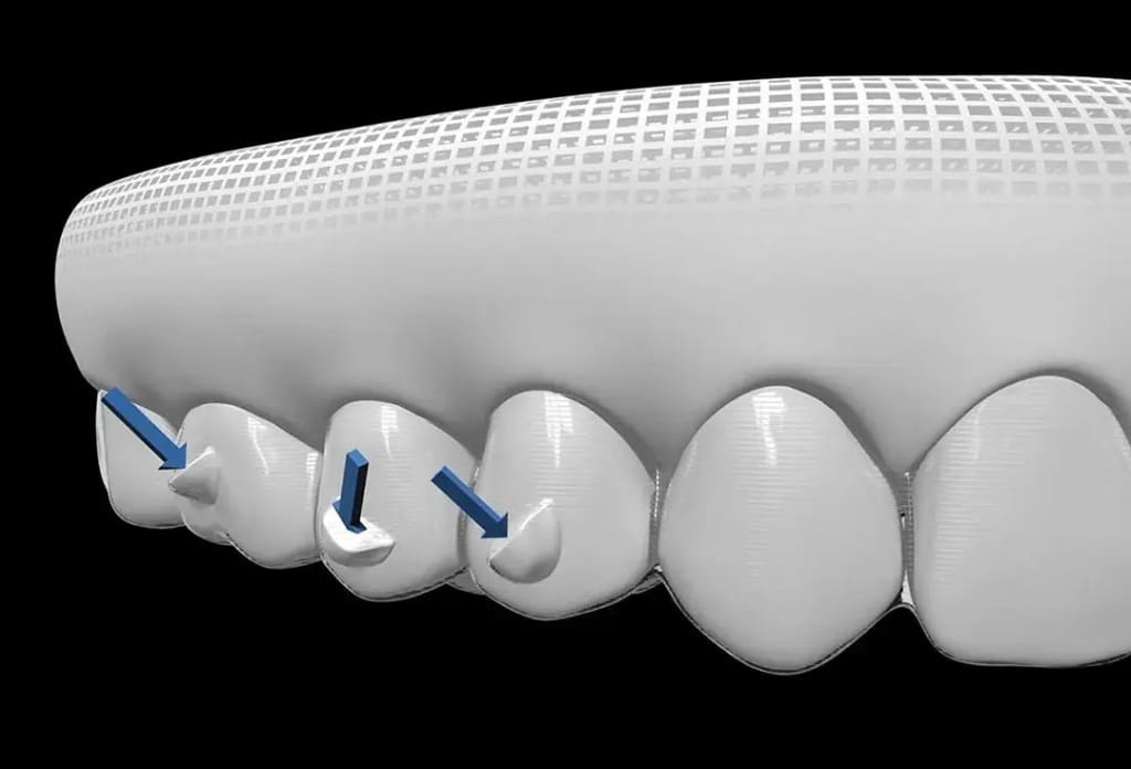 Invisalign Attachments Explained: Comfort, Care & Results