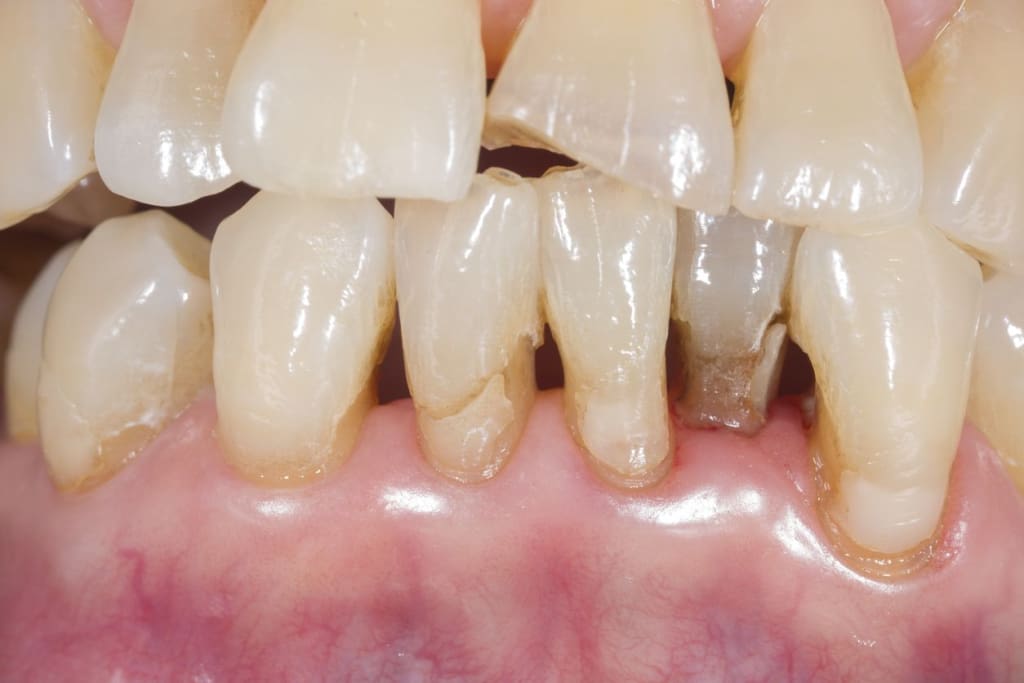 What Does Gum Recession Look Like?