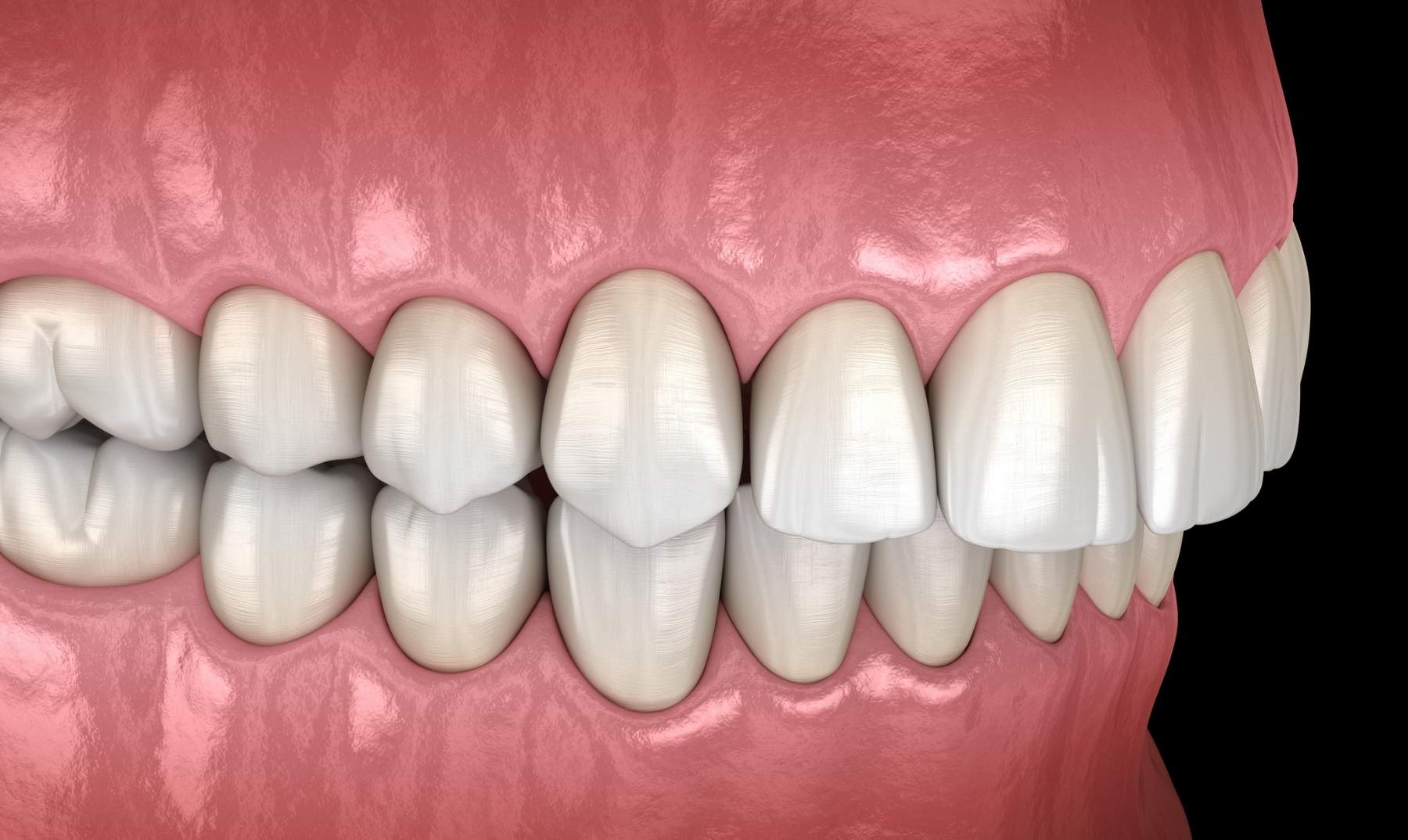 Correcting an Overbite From £63.76 PM