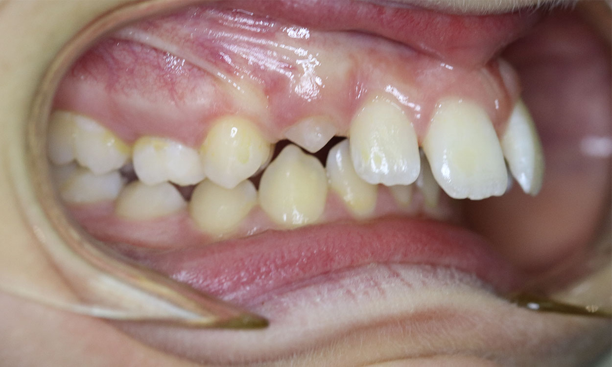 Before