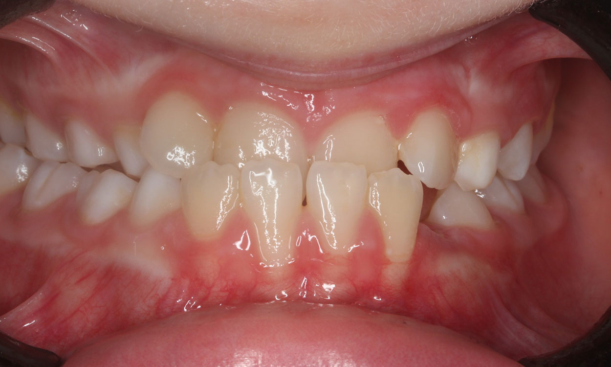 Before